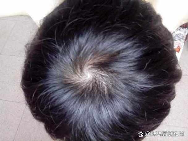 头旋形成的原因